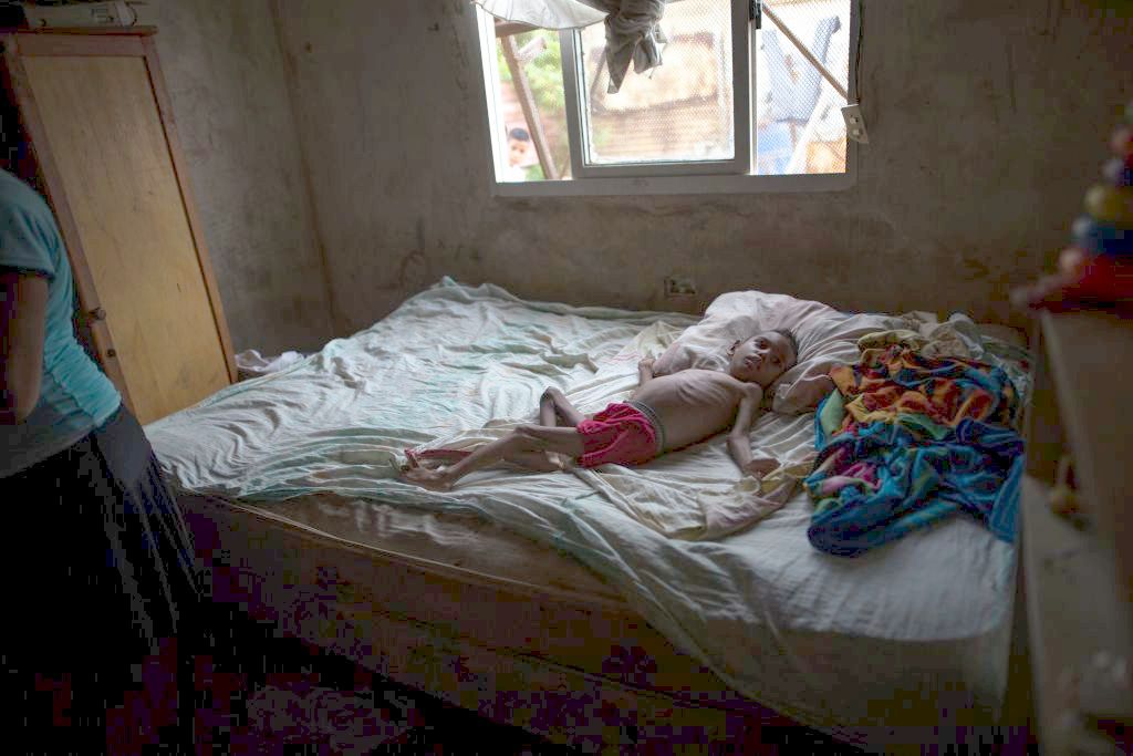 A malnourished boy lies on a bed in Venezuela