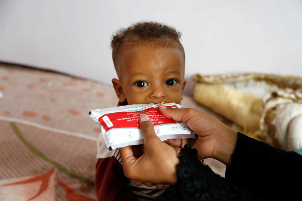 Malnourished child in Yemen Iran’s influence